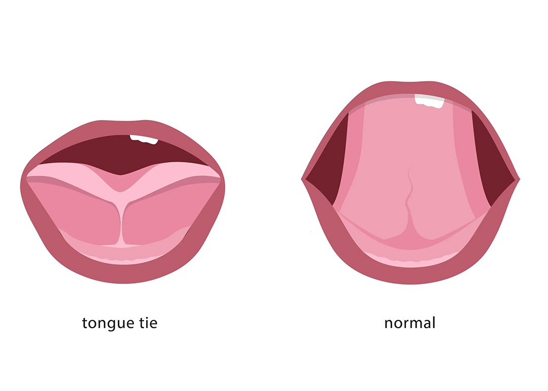 New and Quick Solutions for Lip Tie and Upper Lip Tie in Laurel, Montana