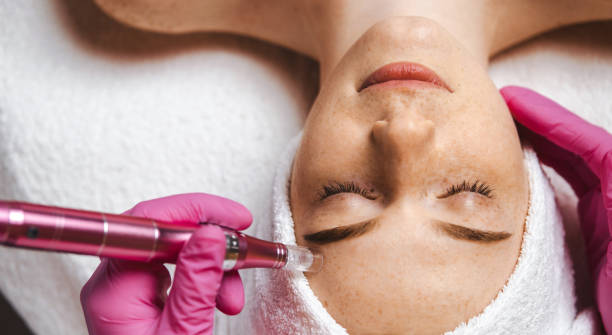 Derma Pen vs. Other Treatments – What’s Best?