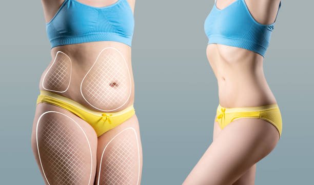 Affordable Liposuction in Riyadh – Prices & Packages
