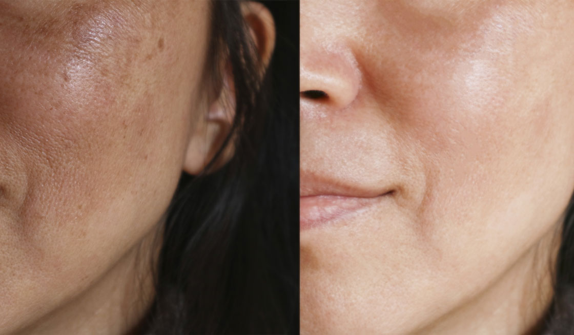 Refresh Your Look with Cold Peel