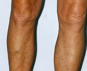 Comprehensive Varicose Veins Solutions