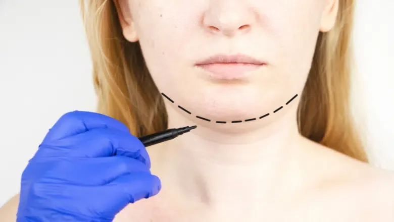 Double Chin Liposuction Before and After Results