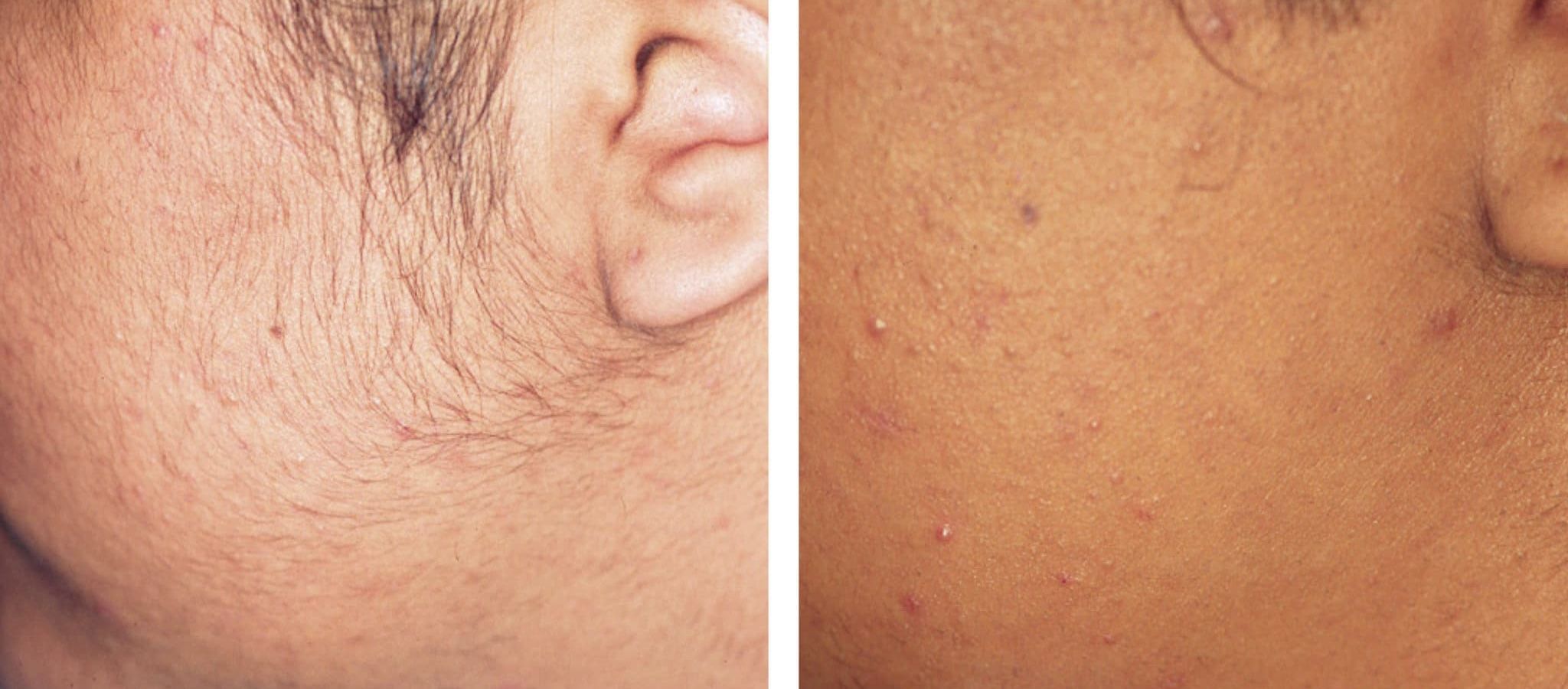 All Skin Types, All Hair Colors: Electrolysis Works for Everyone in Dubai
