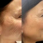 Deliver Shine with Profhilo at Best Aesthetic Clinics in dubai