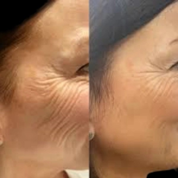 Deliver Shine with Profhilo at Best Aesthetic Clinics in dubai