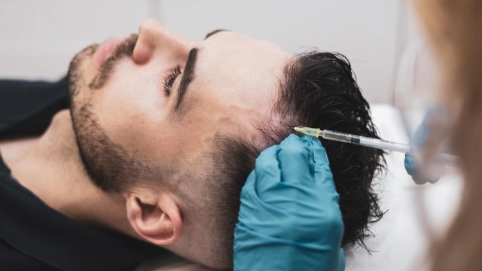 How to Prepare for Your FUSS Hair Transplant