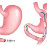 Safe And Effective Swallowable Gastric Balloon In Dubai