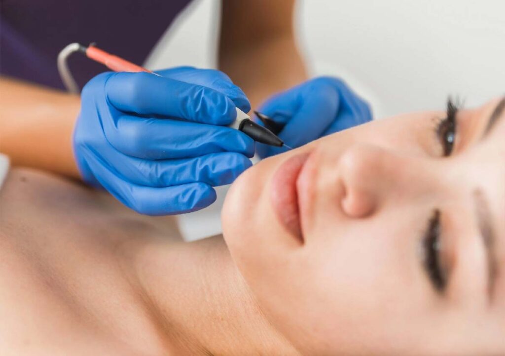 The Hidden Costs of Electrolysis Hair Removal: What to Watch Out For