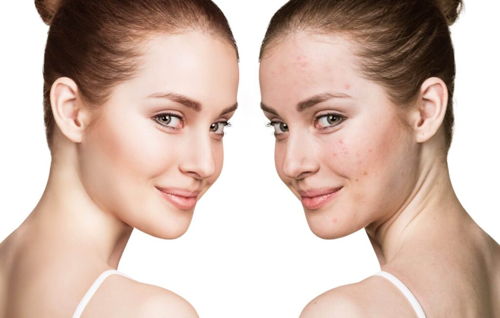 Cold Peel for Redness Reduction