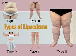 Lipoedema Relief in the UK: How to Improve Your Quality of Life