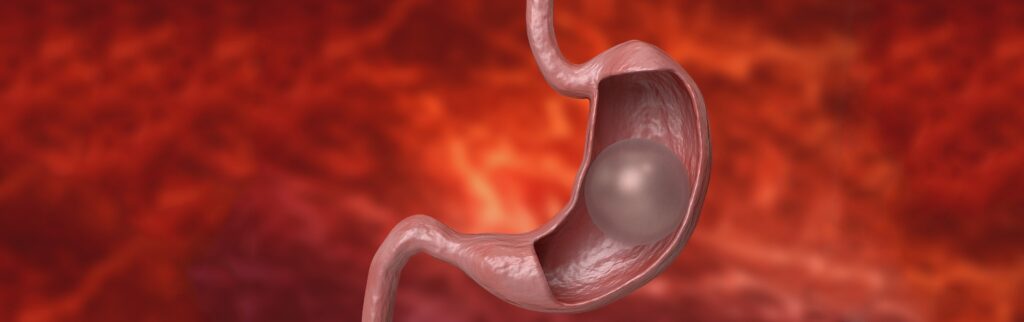 Gastric Balloon Placement Overview