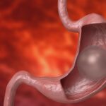 Gastric Balloon Placement Overview