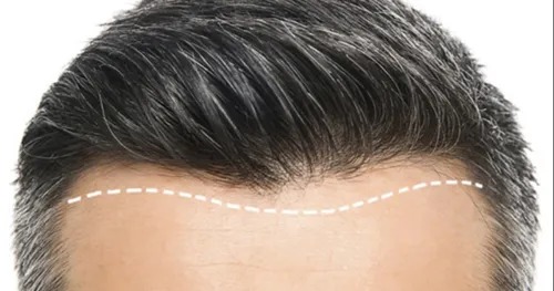 Why Front Line Hair Fixing Works