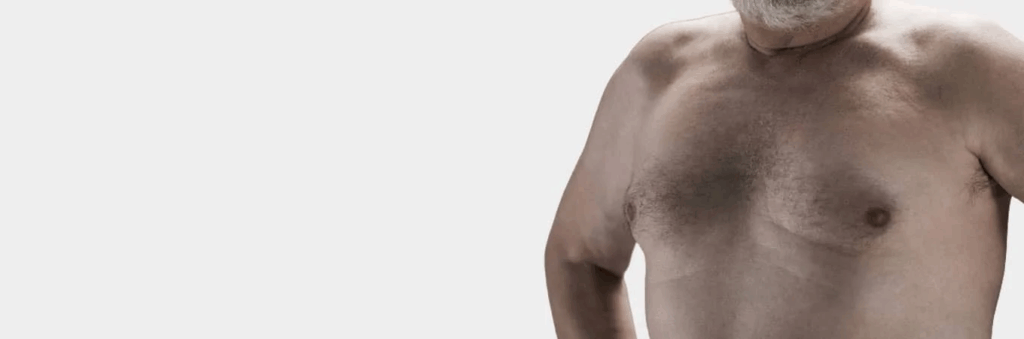 Can Weight Loss Eliminate Gynecomastia?