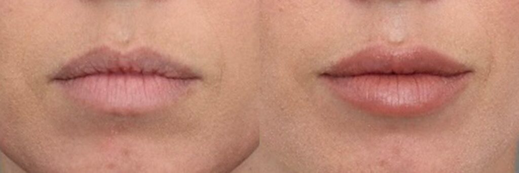 Juvederm Fillers for Chin Shape
