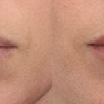 Juvederm Fillers for Chin Shape