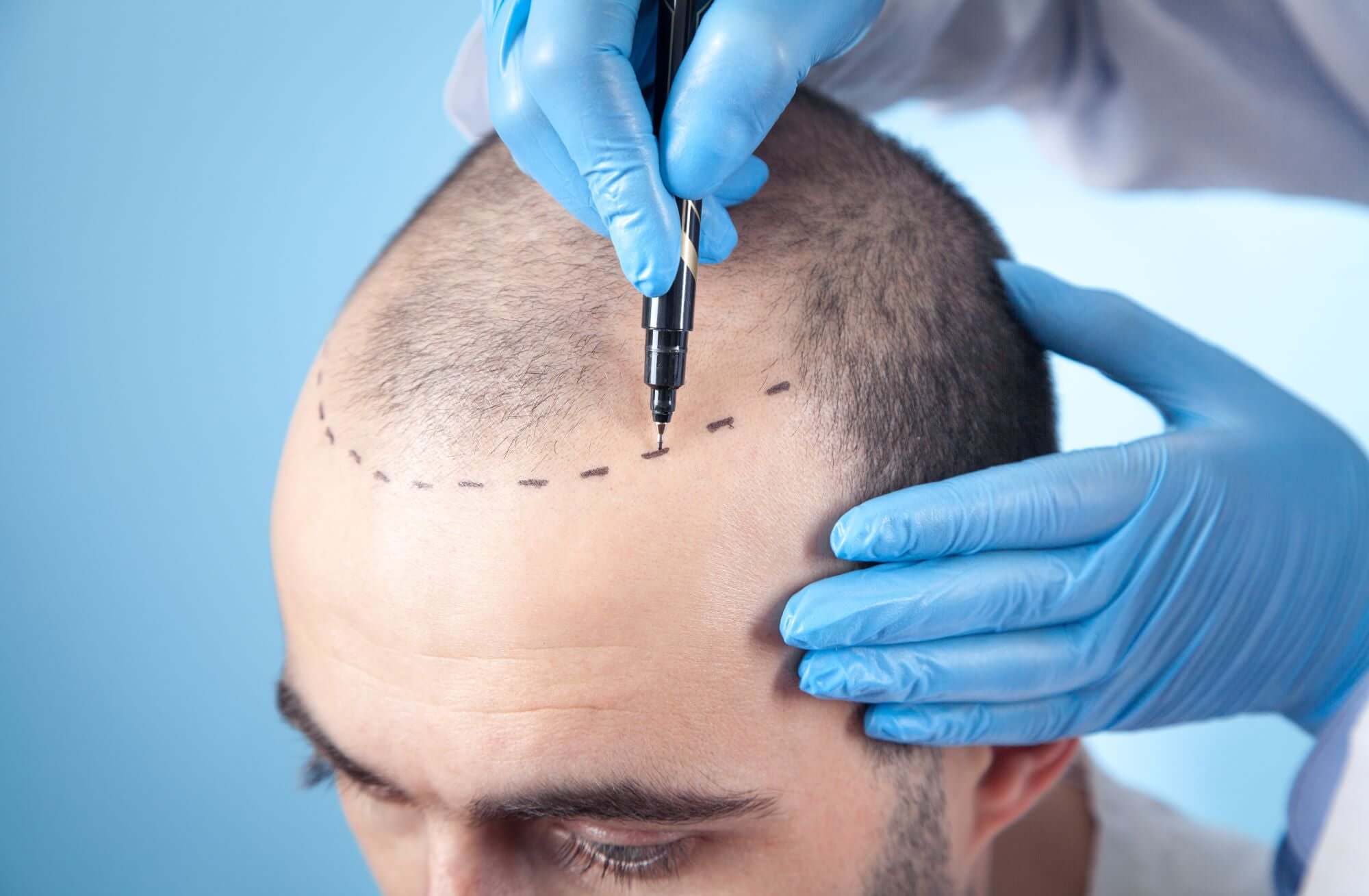 Vorher-Nachher: So verändert eine Haartransplantation Ihr Leben
