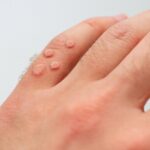 Steps to Understand Skin Wart Removal Costs
