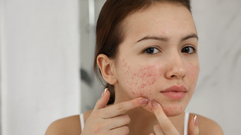 When Should You Start Acne Treatment in Dubai?