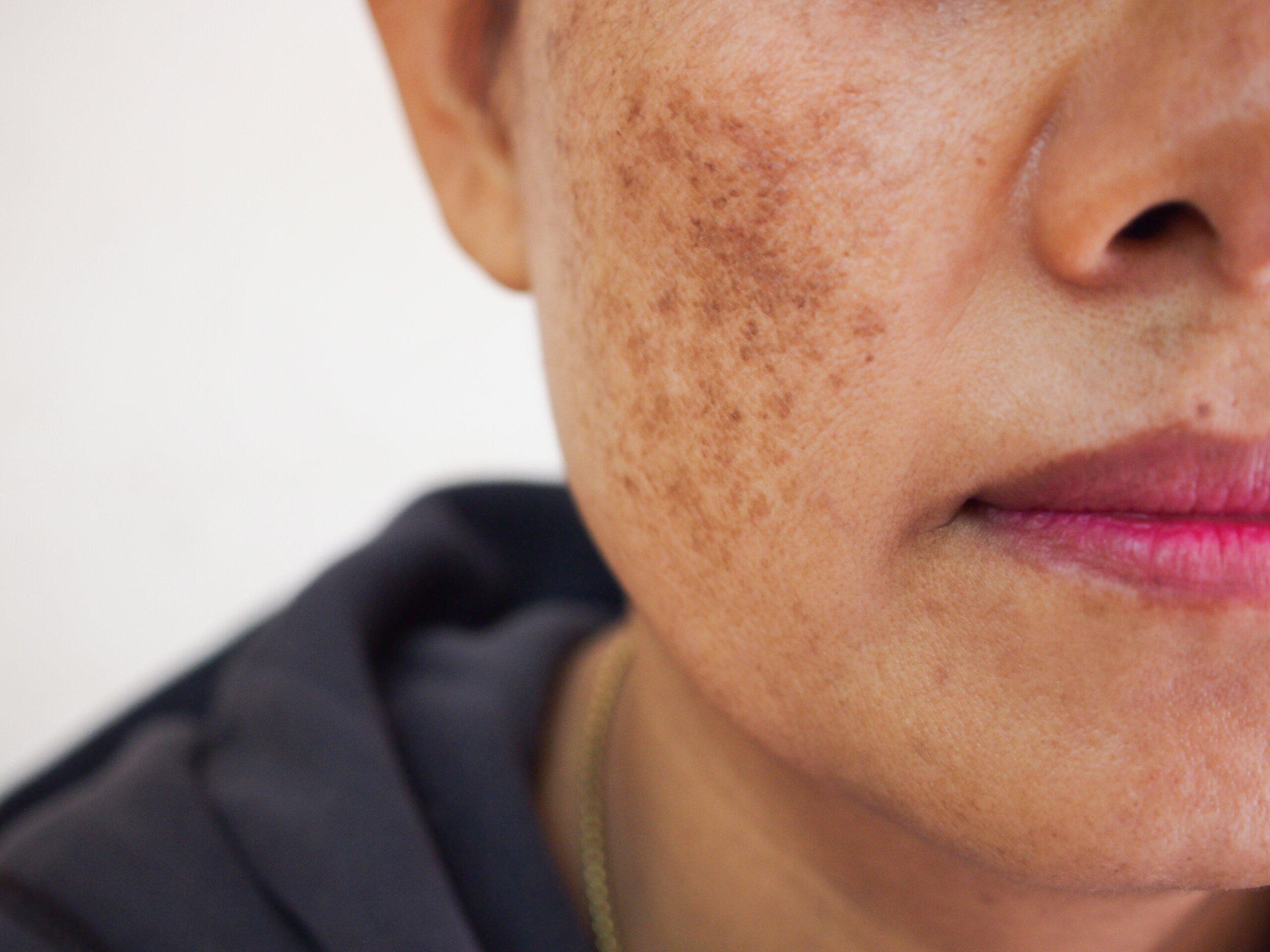 Say Goodbye to Facial Wrinkles with Plasma Pen