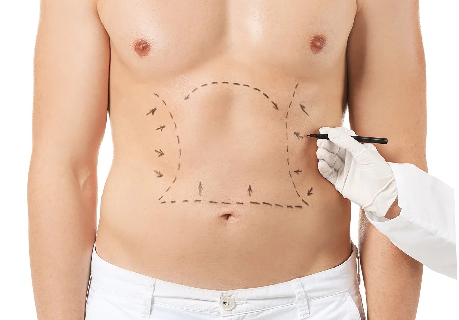 Understanding the Healing Process After a Tummy Tuck