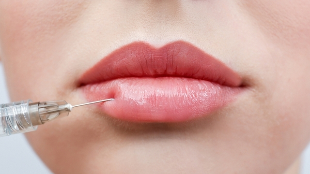 Best Lip Fillers Injections in Dubai
