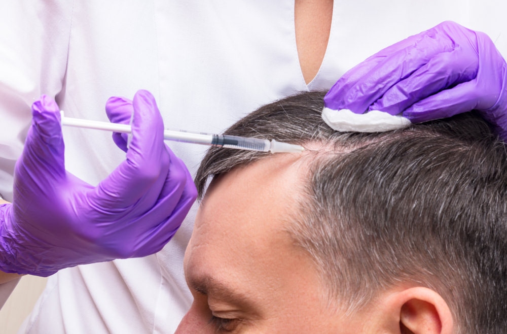 Best PRP Hair Treatment in Dubai