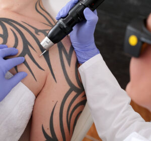 Best Time to Start PicoSure Tattoo Removal 