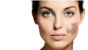 Say Goodbye to Birthmarks at Dynamic Aesthetic Dubai