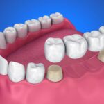 Dental Crowns and Bridges Info