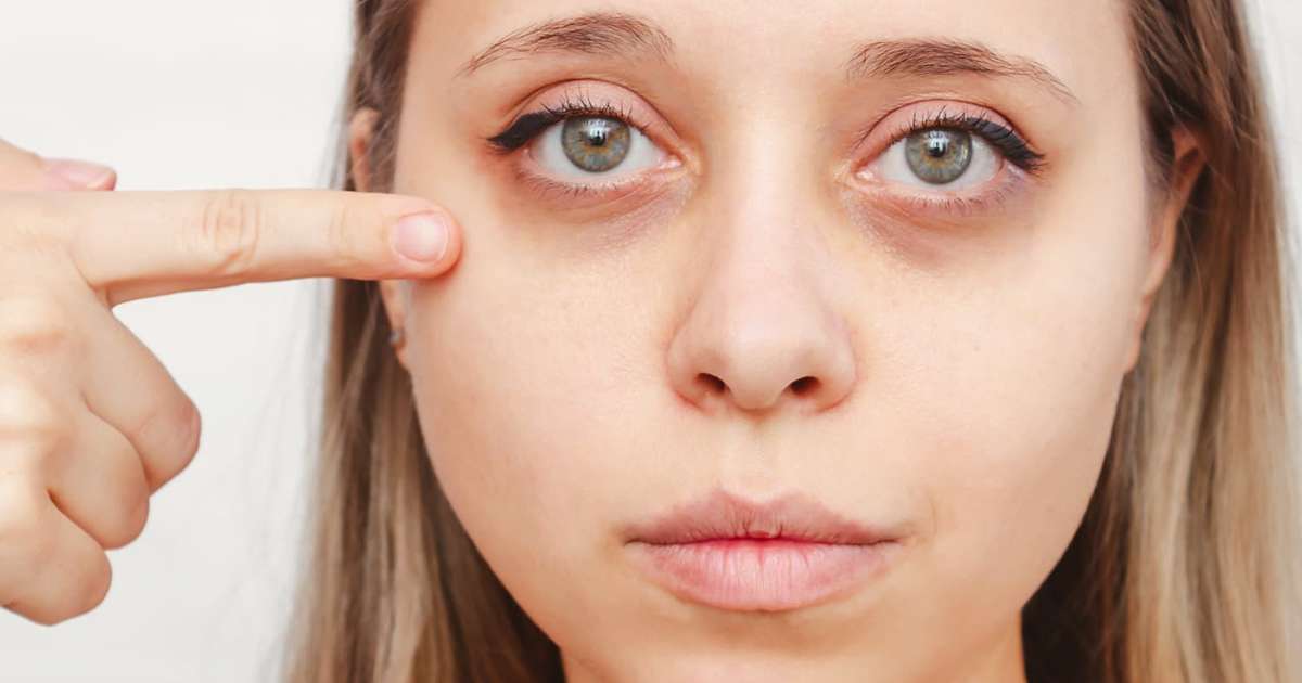 Dark Circles Treatment In Dubai