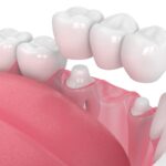 Learn About Dental Crowns and Bridges