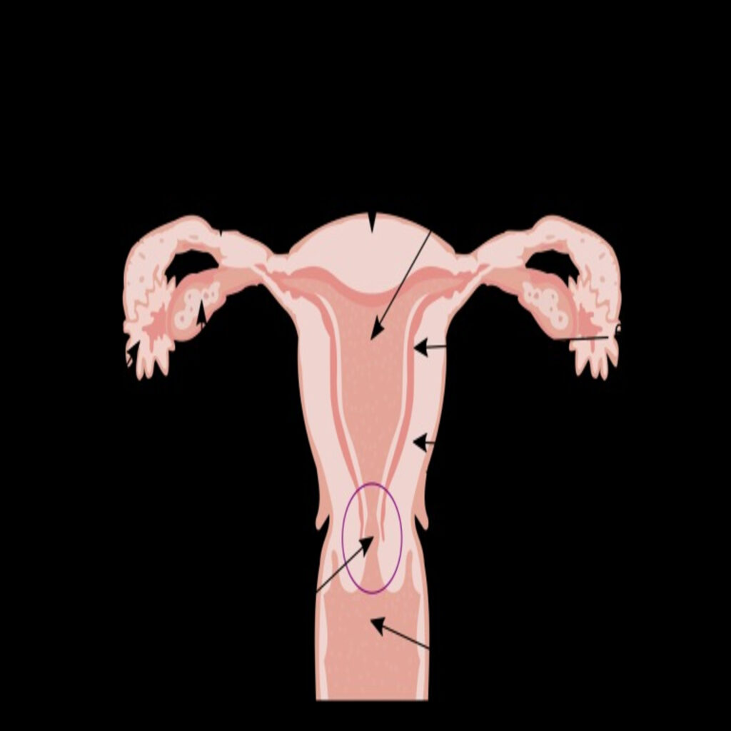 Fibroid Ablation: A Minimally Invasive Solution for Uterine Fibroids