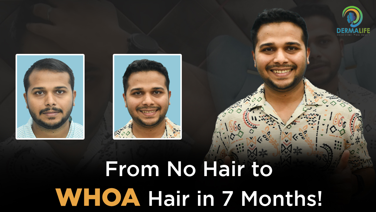 Hair Transplant in Delhi: Side Effects You Should Know