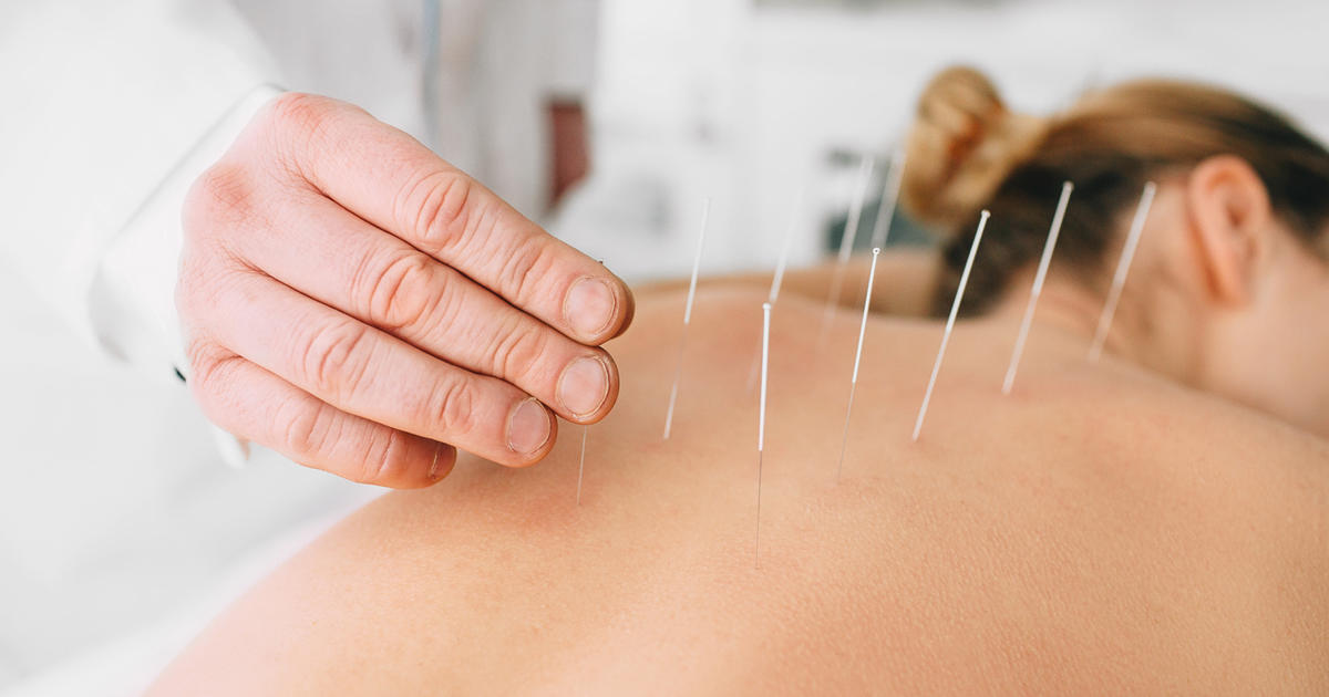 How Acupuncture Boosts Health: Benefits You Should Know