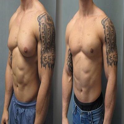 Cost Breakdown: Male Breast Reduction