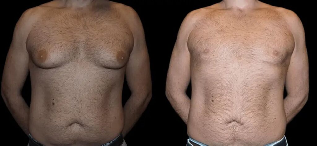 Understanding the Recovery Timeline for Gynecomastia in Dubai