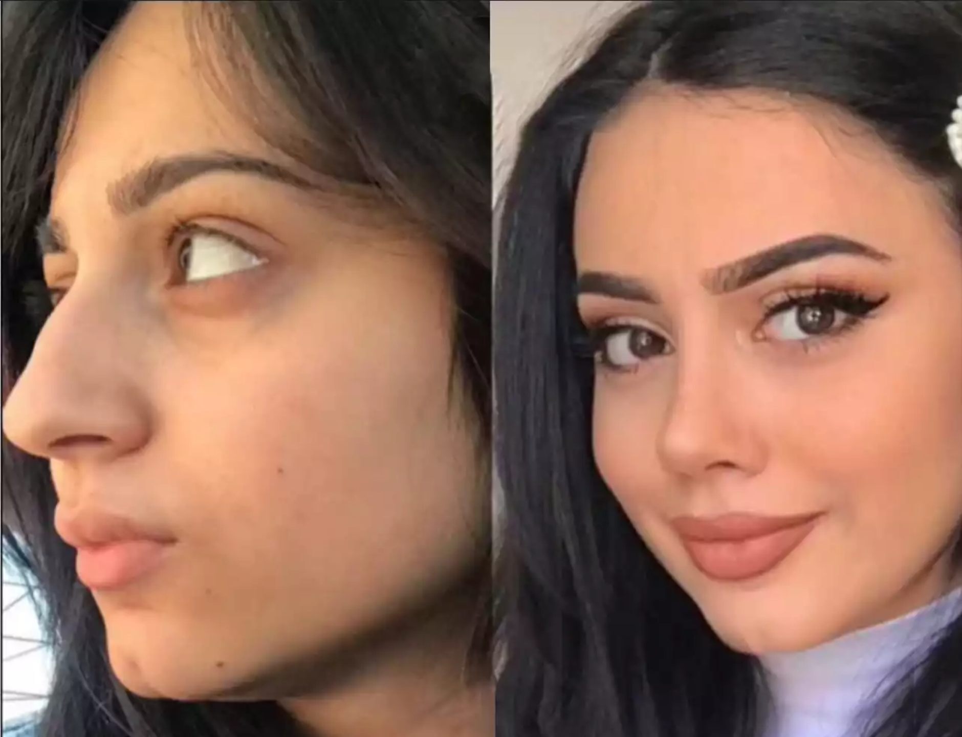 Cost and Value: Finding the Best Rhinoplasty Surgeons in Dubai