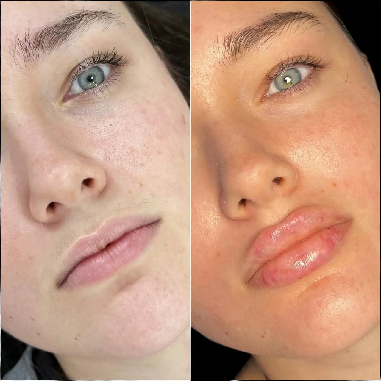 How the Best Doctors in dubai Use Fillers to Enhance Natural Beauty