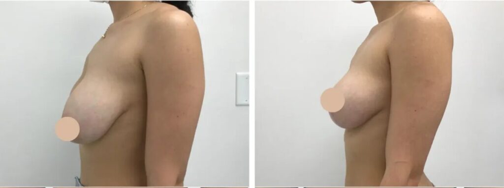 What Makes a Breast Lift Surgeon the Best in Dubai?