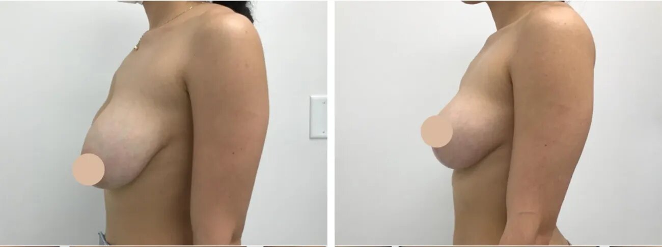 What Makes a Breast Lift Surgeon the Best in Dubai?