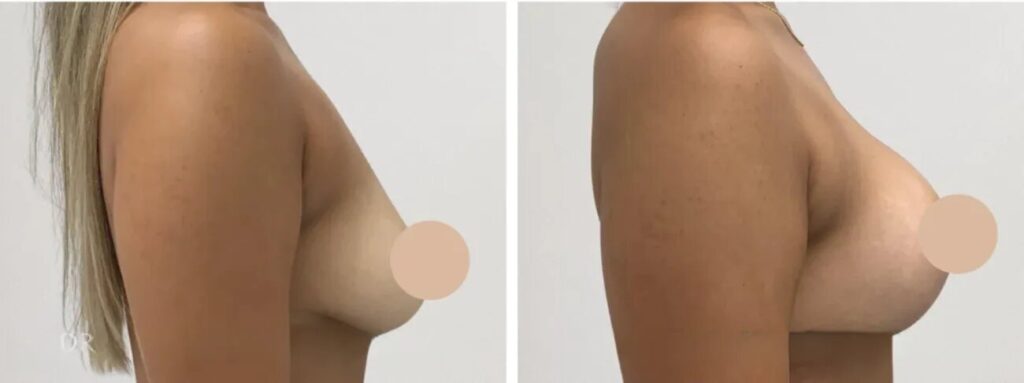 Breast Lift in Dubai for Women After Menopause: What to Know