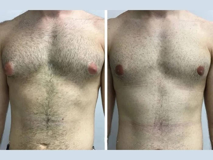 What Makes the Best Doctors in Dubai the Right Choice for Gynecomastia Treatment?