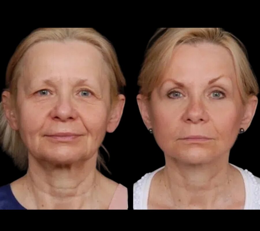 The Best Under Eye Fillers for Different Age Groups at the Best Aesthetic Clinics in Dubai