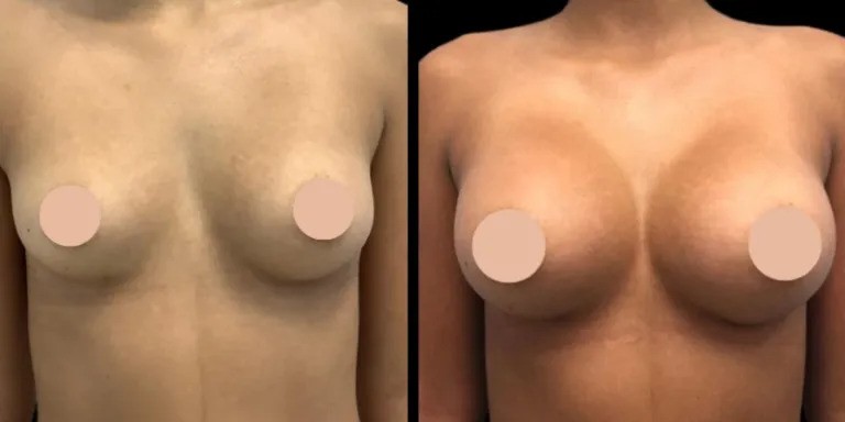 What Sets the Best Breast Augmentation Surgeons in Dubai Apart from Others Globally