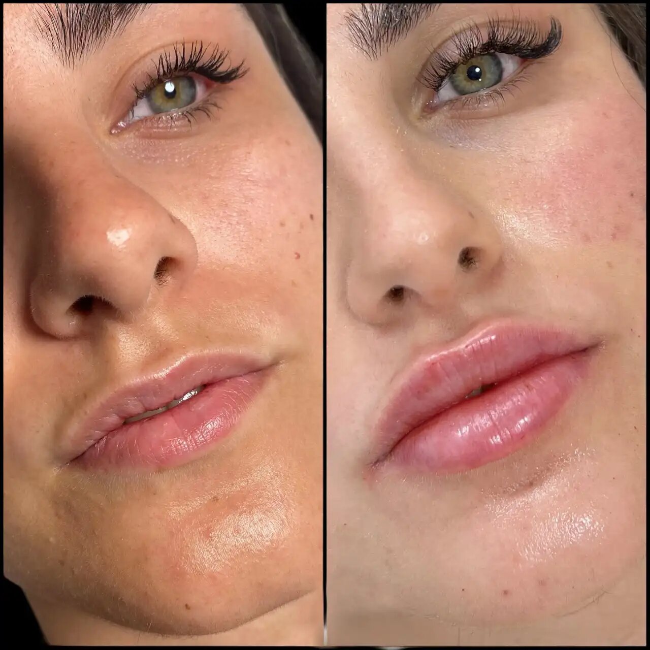 What Sets the Best Aesthetic Clinics in dubai Apart for Fillers