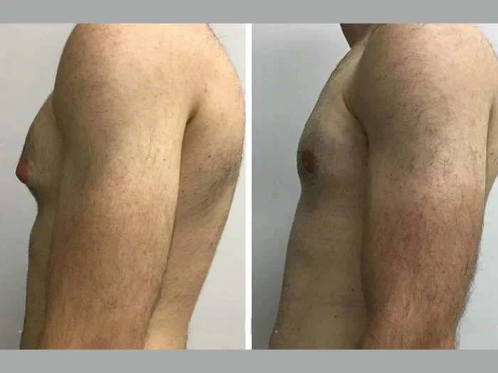 How Gynecomastia Can Boost Your Confidence in Dubai