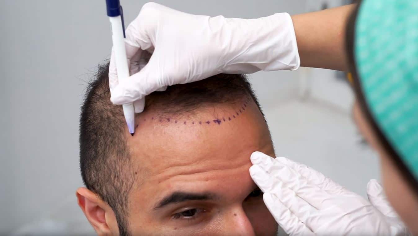 Hair Transplant in Dubai