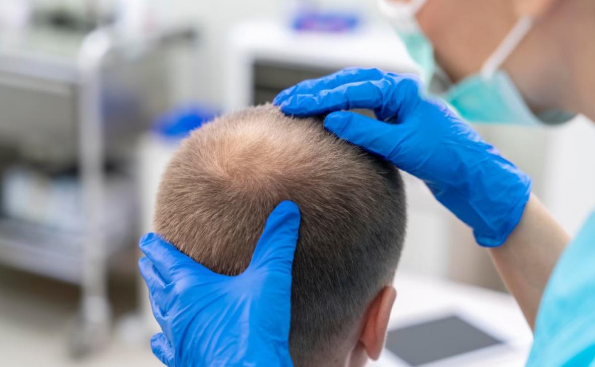 Top-Rated Hair Transplants for a Fuller Look