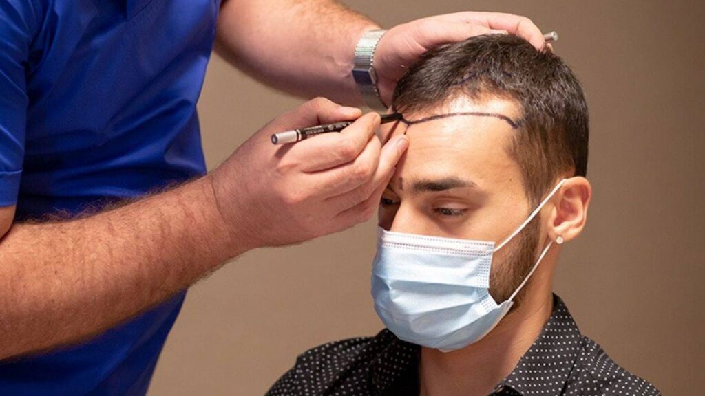 Hair Transplant vs. Wigs or Hairpieces in Islamabad
